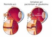 Glaukoma_acs